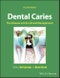Dental Caries. The Disease and its Clinical Management. Edition No. 4 - Product Image