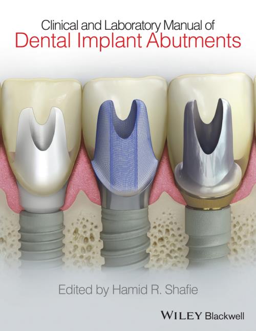 Clinical and Laboratory Manual of Dental Implant Abutments ...