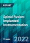 Spinal Fusion: Implanted Instrumentation - Product Thumbnail Image