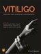 Vitiligo. Medical and Surgical Management. Edition No. 1 - Product Image